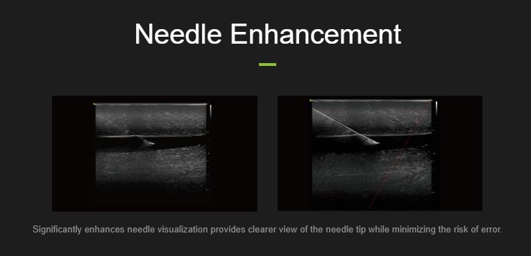 Uitbreiding echo image needle enhancement - Vinno